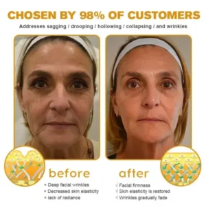 Botulin Bee Poison Wrinkle Removal Cream