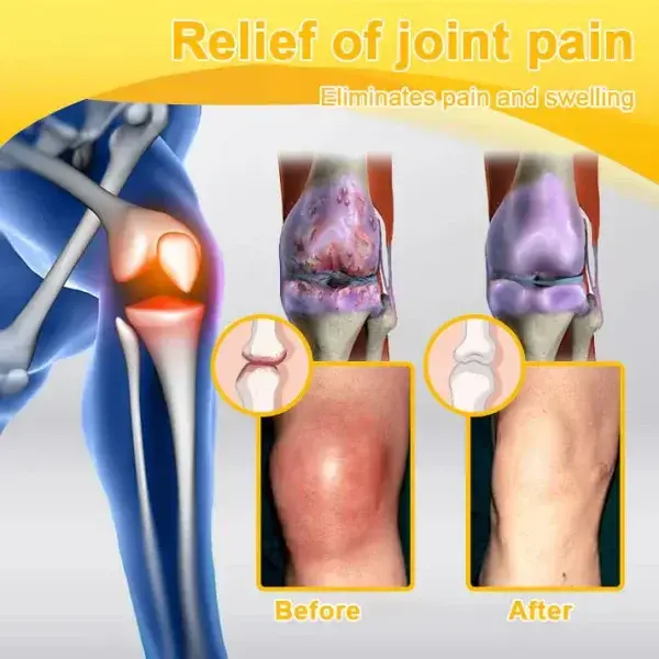 Botulinum Toxin & Bee Venom Pain-Relief Bone Healing Cream