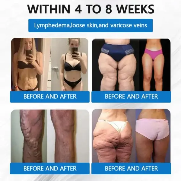 Nano Microneedle Weight Loss Patch