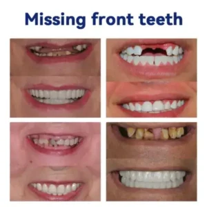 Silicone Denture Ruler Set