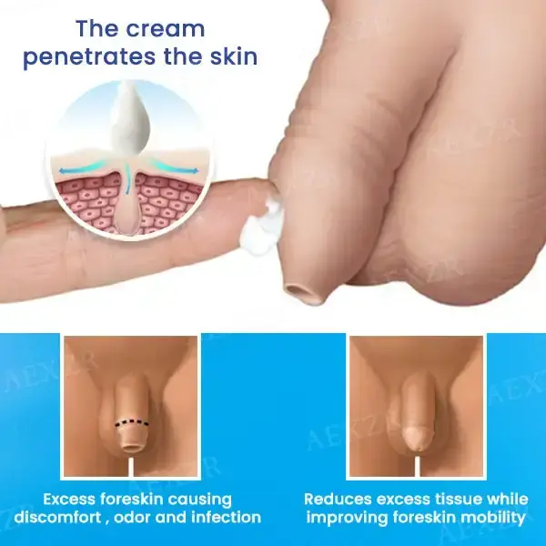 Foreskin Cream Solution - 70% OFF - Image 3