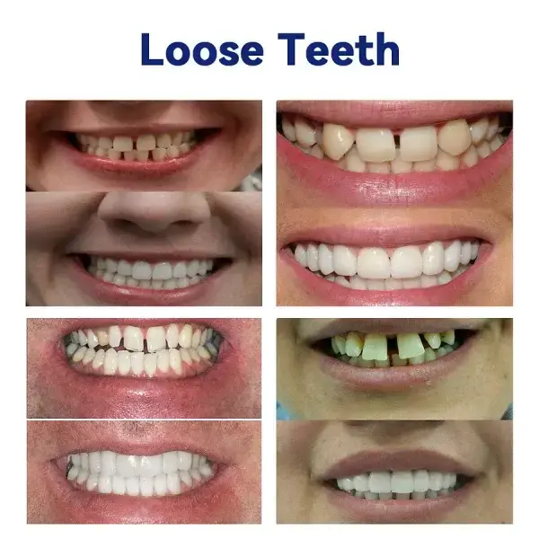 Advanced Customized Full Denture Set