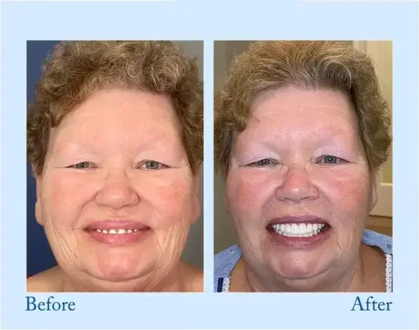 Advanced Customized Full Denture Set - Image 5