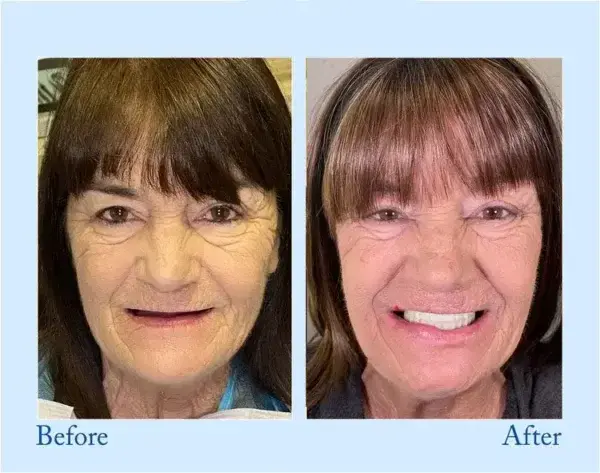 Advanced Customized Full Denture Set - Image 6