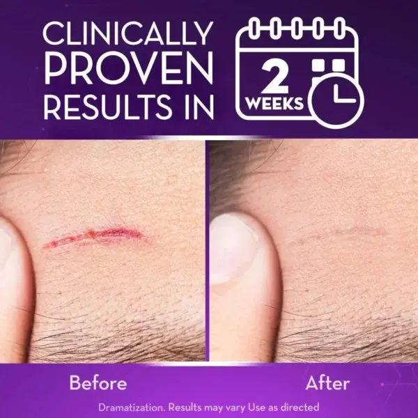 Advanced Scar Gel