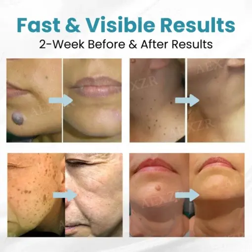 Non-Invasive Mole and Wart Removal Laser Pen - Image 2