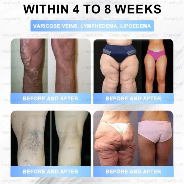 Tirzepatide Slimming & Health Nano Microneedle Patch - Image 5