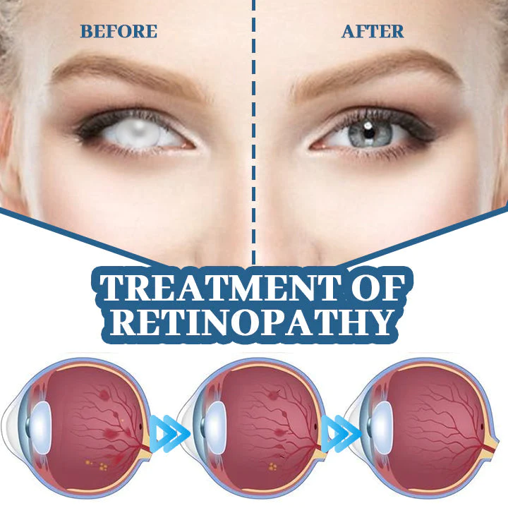 Myopia Reversal Eye Drops - Image 4