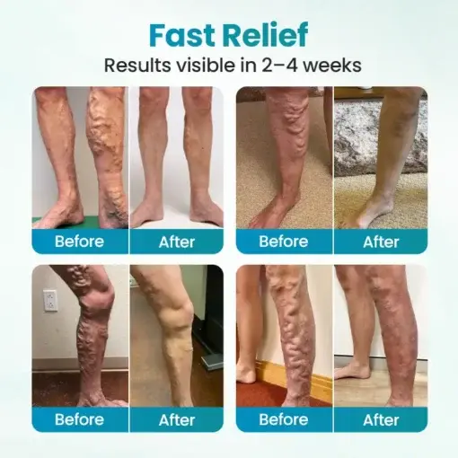 VeinAway Relief Cream - Image 6