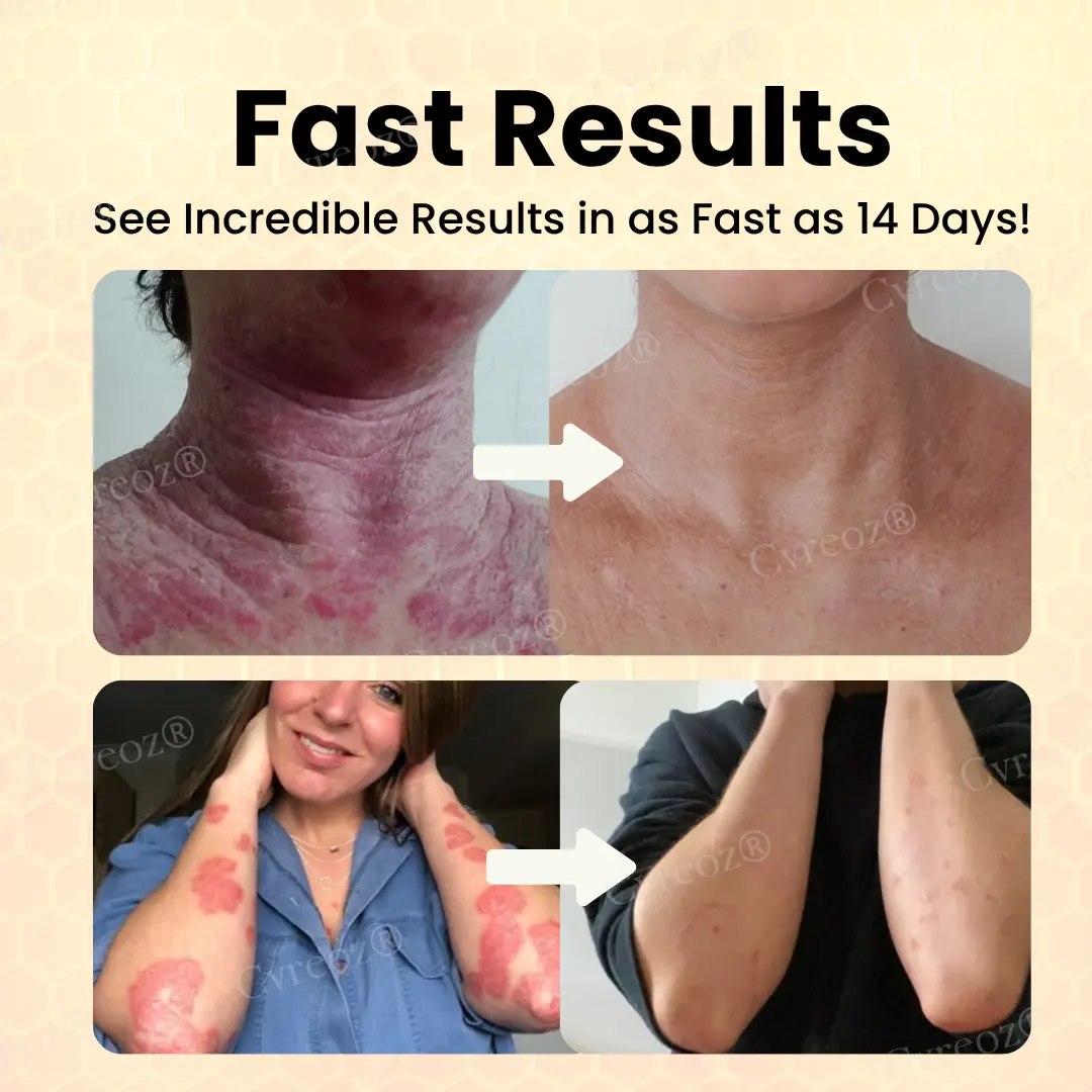 Bee Venom Psoriasis Cream - Image 2