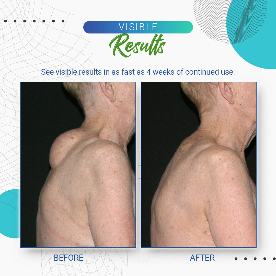 Cvreoz Lipoma Removal Cream - Image 9