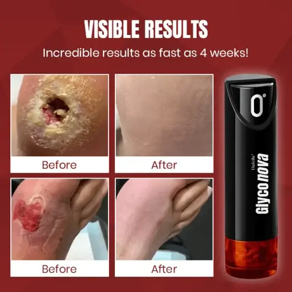 Dafeila® Glyconova Blood Sugar Inhaler - Image 2
