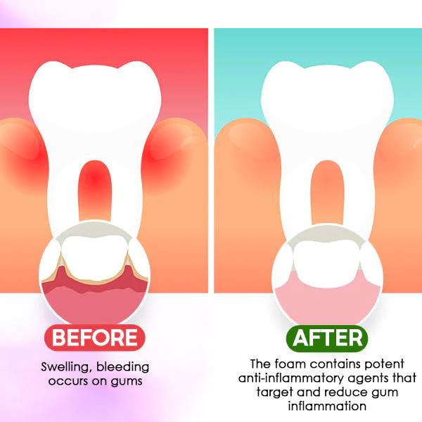 Gum Treatment Foam - Image 6