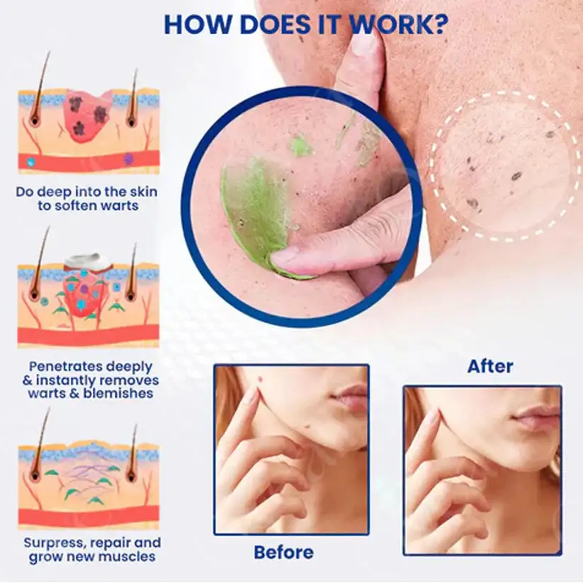 NatureErase Instant Mole & Spot Removal Gel - Image 12
