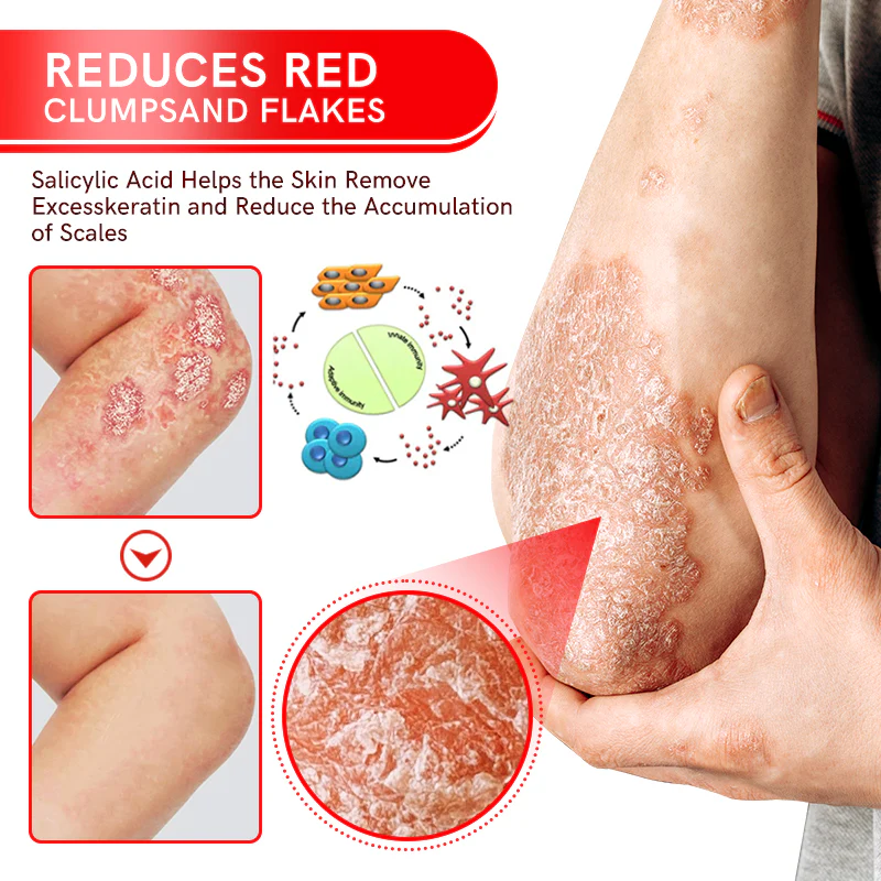Multi-Symptom Bee Venom Psoriasis Treatment Spray - Image 5