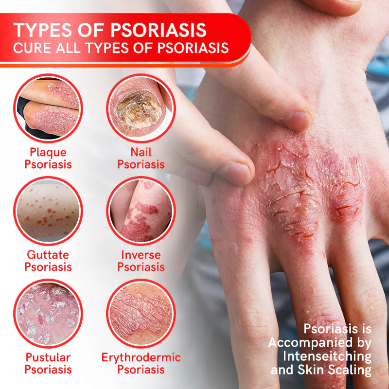 Multi-Symptom Bee Venom Psoriasis Treatment Spray - Image 3