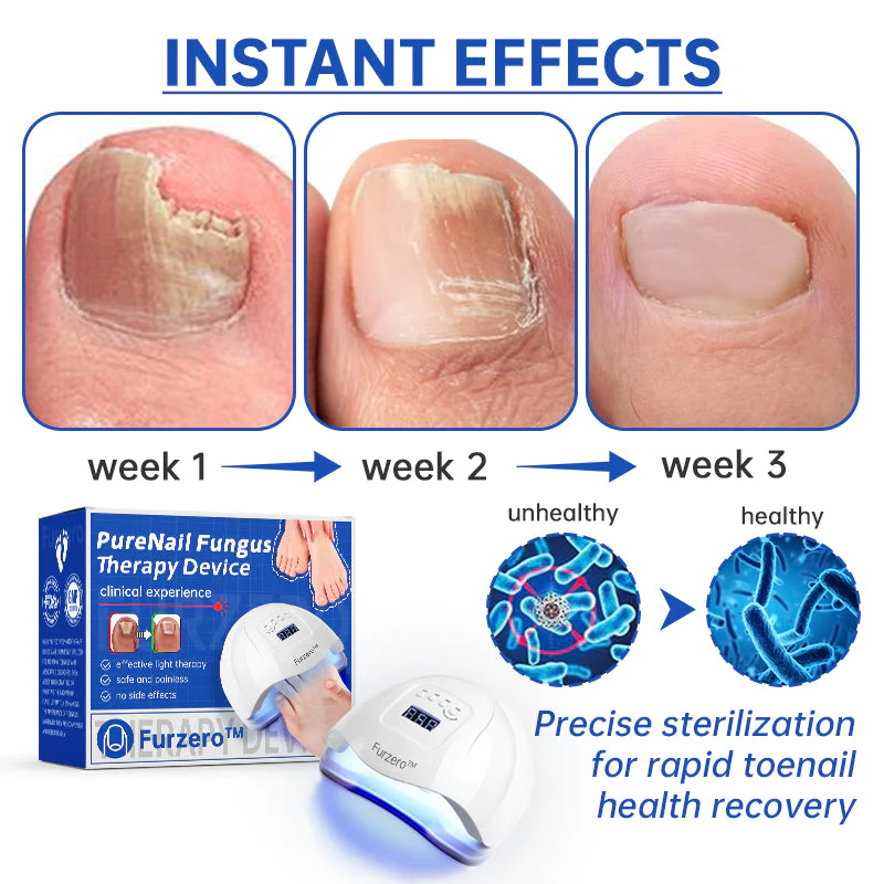 PureNail Fungus Laser Therapy Device - Image 6
