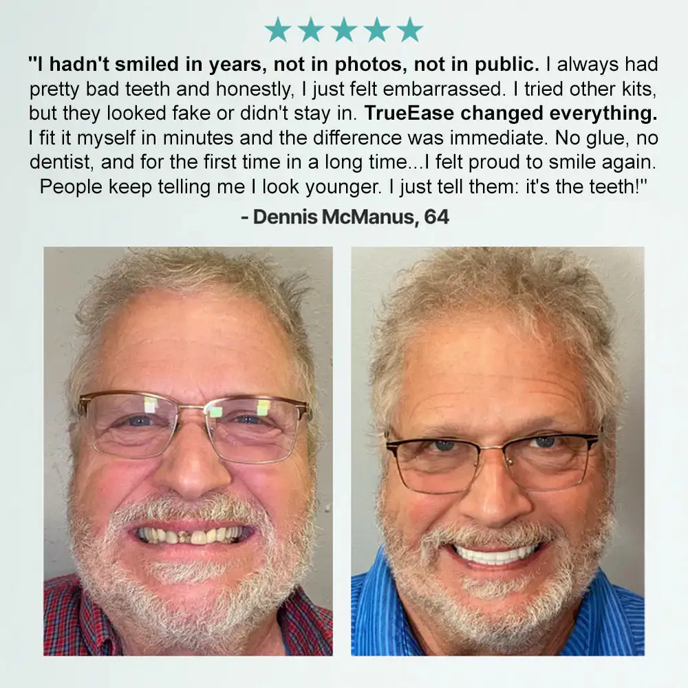 Advanced Customized Full Denture Set - Image 4