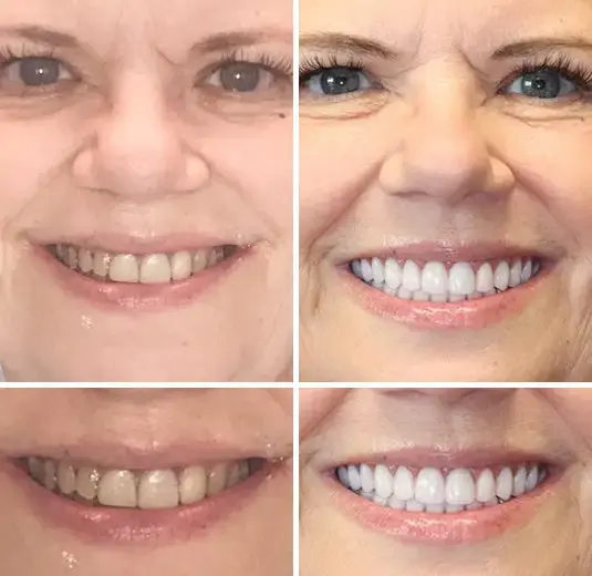 Full Denture Set Advanced Self-Adjusting Dental Materials - Image 6