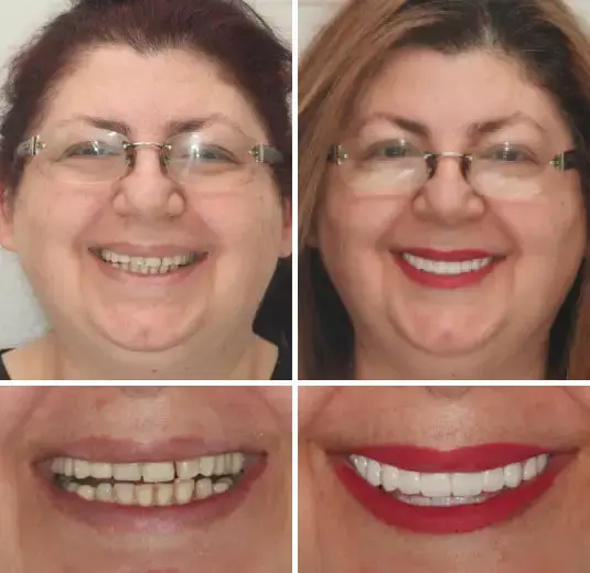 Full Denture Set Advanced Self-Adjusting Dental Materials - Image 7