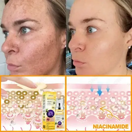 Bee Venom Senile Purpura Cream - Image 13