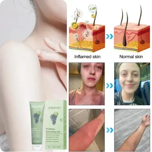 Purifying Exfoliating Gel for Acanthosis Nigricans - Image 11