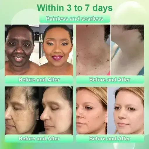 Purifying Exfoliating Gel for Acanthosis Nigricans - Image 3