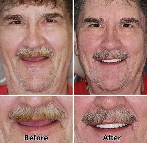 Advanced Custom-Fit Functional Dentures - Image 3