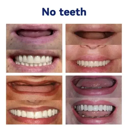 - Advanced Customized Full Denture Set - Image 8