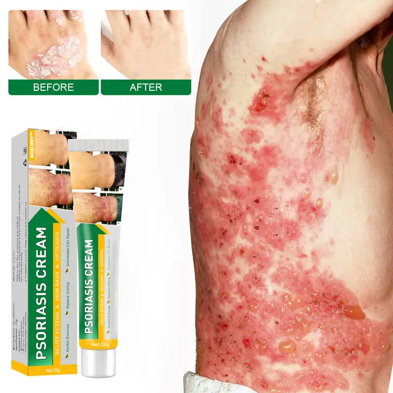 Psoriasis Cure Cream - Image 10
