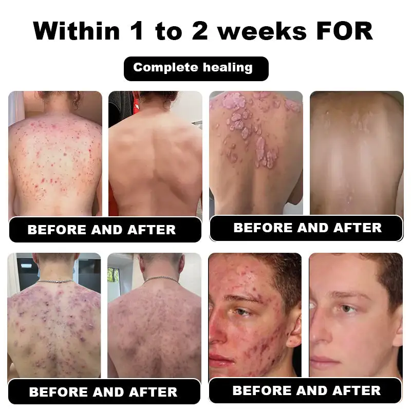 Psoriasis Cure Cream - Image 3