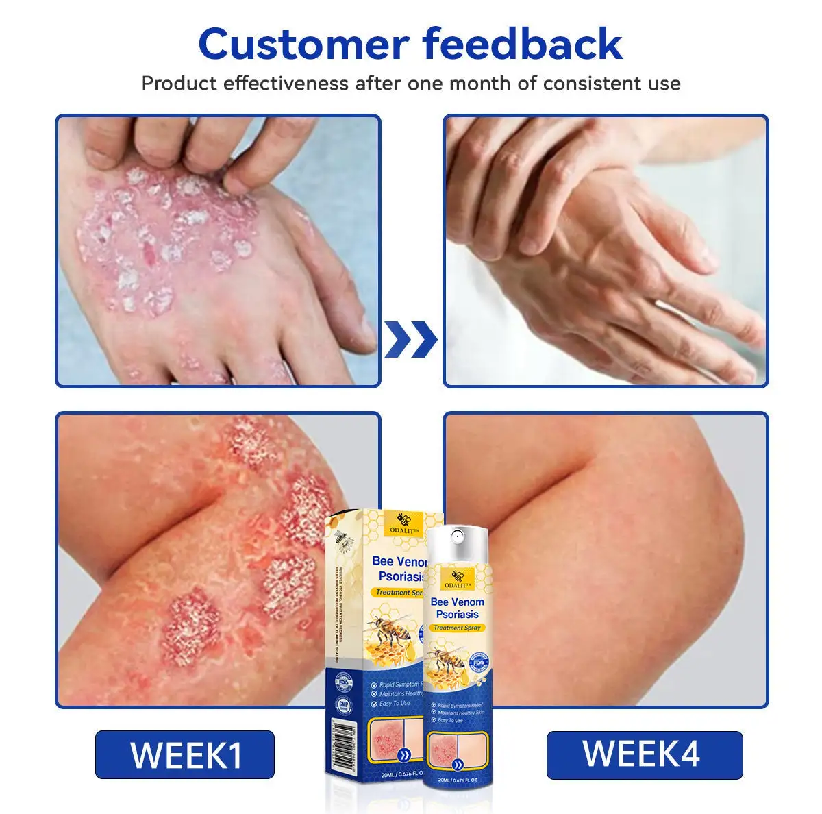PsoriaHeal psoriasis Spray - Image 10