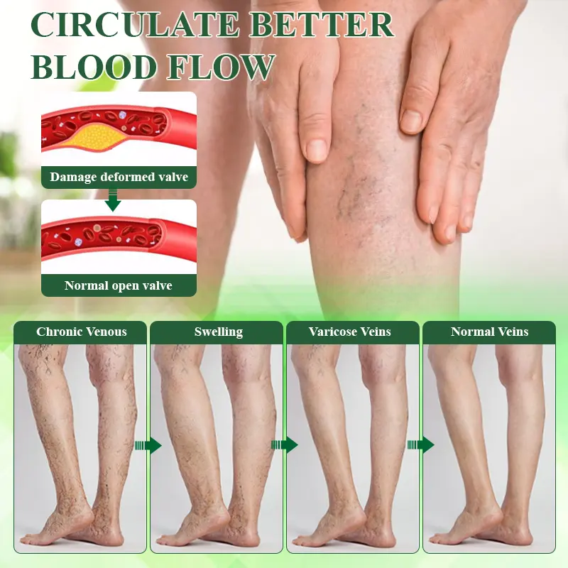 VeinoRoll Therapy Edema Comfort Cream - Image 7