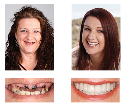 3D Dentures - Image 5