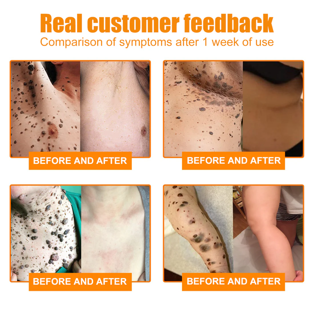 Bee Venom Mole and Wart Treatment Spray - Image 3