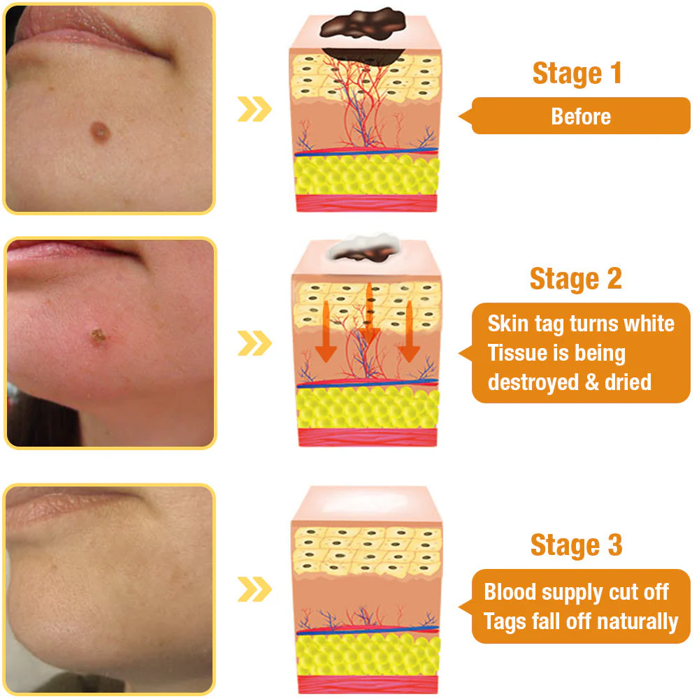 Bee Venom Mole and Wart Treatment Spray - Image 8