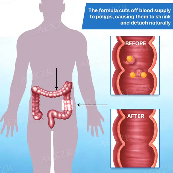 Colon and Polyps Removal Cure - Image 4