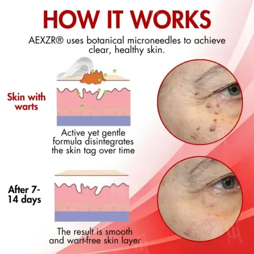 Nano-Microdart Skin Tag & Spot Corrector Patches - Image 5