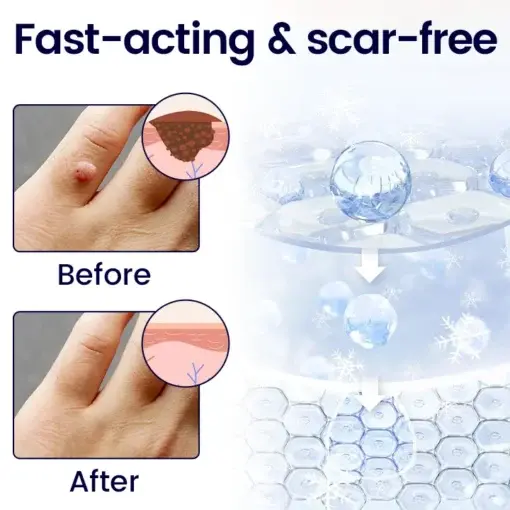 WartErase Cryo Freeze Spray - Image 4