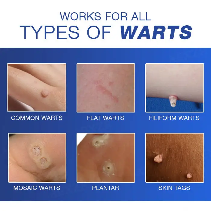 Wart Eraser Pro - Image 6