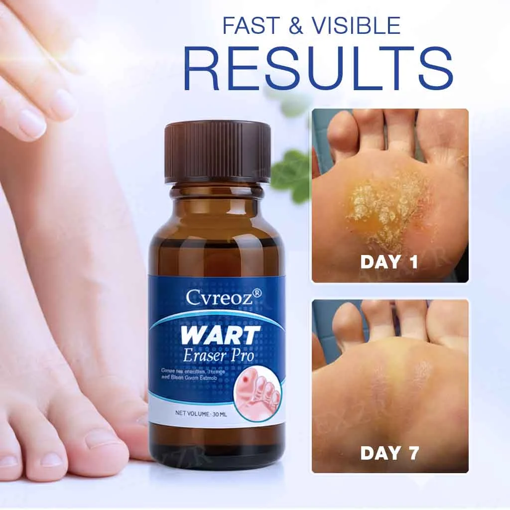 EXCLUSIVE DEAL! 32% OFF - Wart Eraser Pro - Image 2