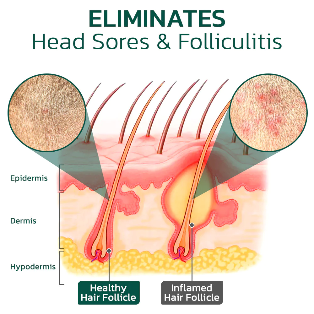 Scalp Folliculitis Therapy Oil - Image 3
