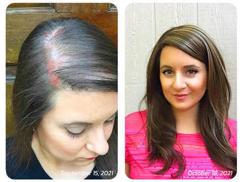 Scalp Folliculitis Therapy Oil - Image 7