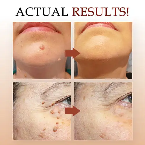 Concentrated potent skin tag removal cream - Image 6
