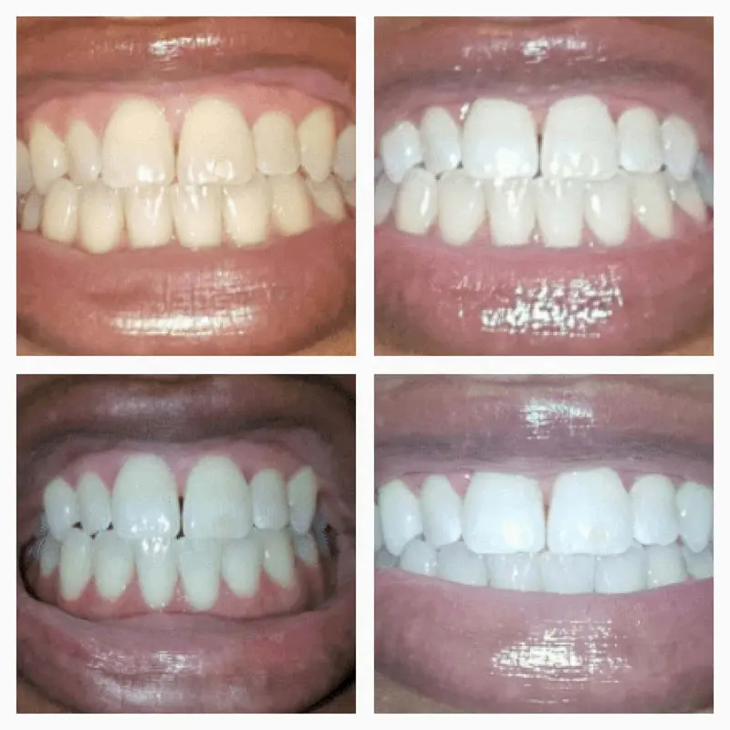 Extra-Strength Teeth Whitening Serum Pen + Dual-Peroxide Formula & Xylitol - Image 4