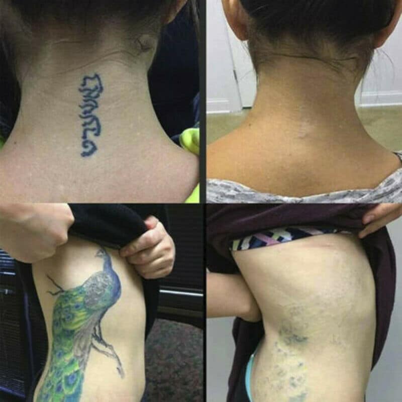 Permanent Tattoo Removal Cream - Image 4