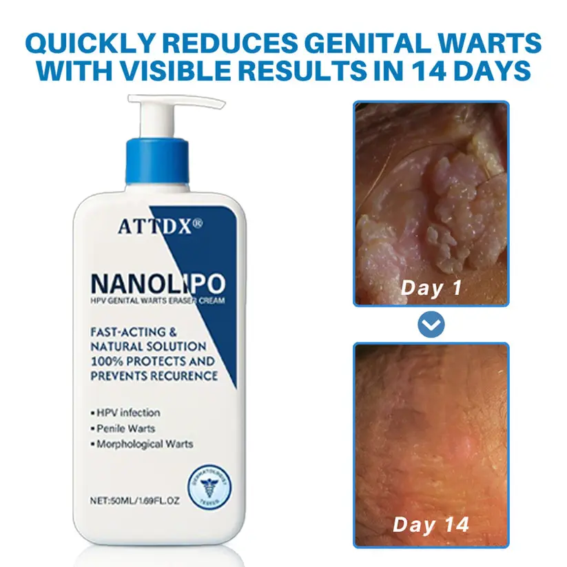 NanoLipo HPV Genital Warts Eraser Cream