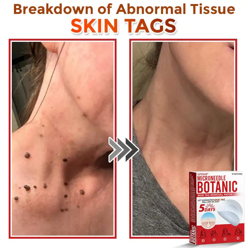 MicroNeedle Botanic Skin Tag Removal Patch - Image 4