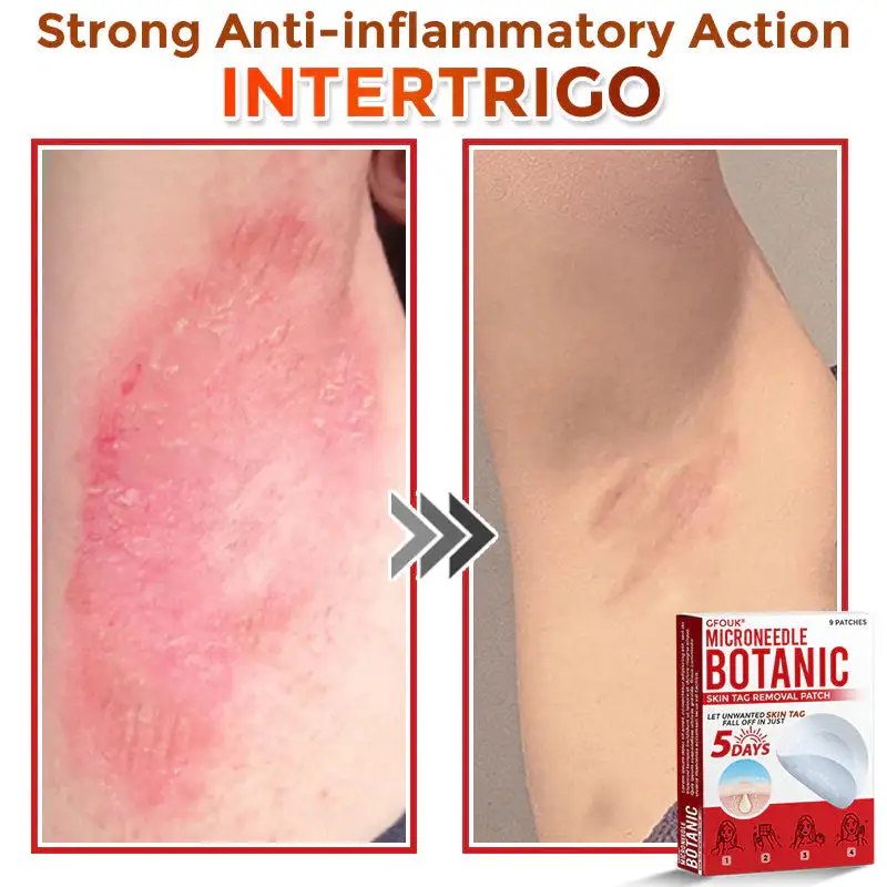 MicroNeedle Botanic Skin Tag Removal Patch - Image 8
