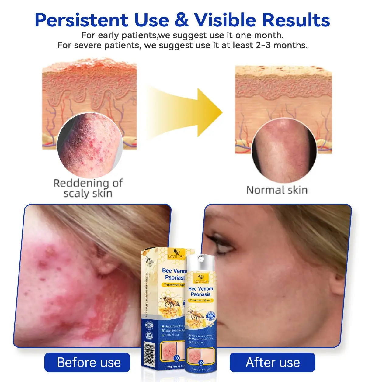 PsoriaHeal Bee Venom Psoriasis Treatment Spray - Image 3